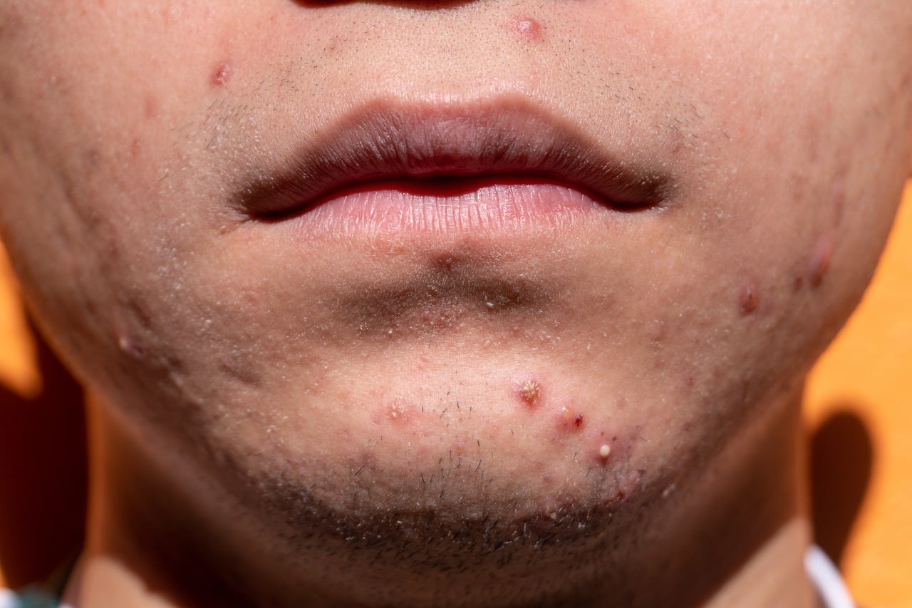 Como eliminar el acne