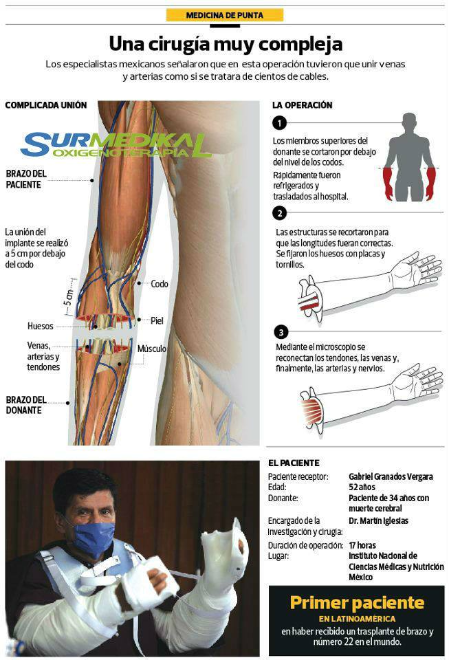 Trasplante de Mano y Brazo