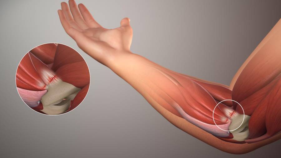 Trasplante de Musculos y Nervios